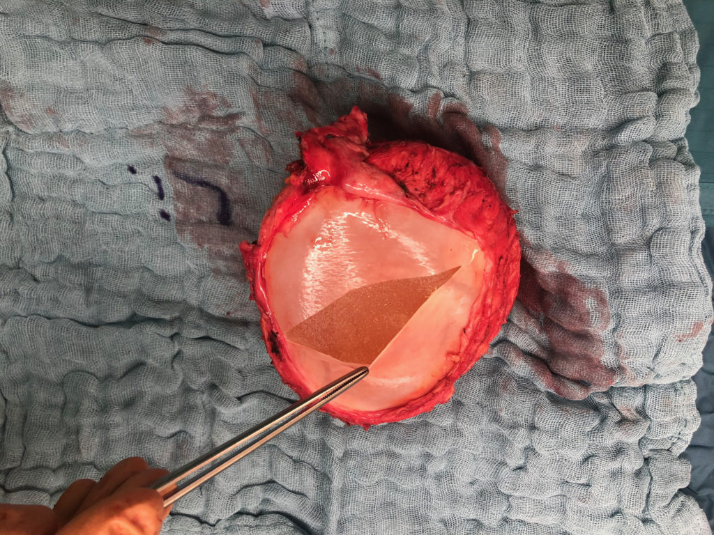 Doppelkapsel (außen: rot/innen: weiß) und Blick auf das Implantat